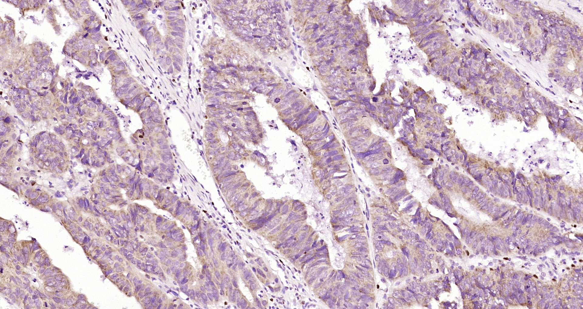 Paraformaldehyde-fixed, paraffin embedded Human rectal cancer; Antigen retrieval by boiling in sodium citrate buffer (pH6.0) for 15min; Block endogenous peroxidase by 3% hydrogen peroxide for 20 minutes; Blocking buffer (normal goat serum) at 37°C for 30min; Antibody incubation with EFR3A Polyclonal Antibody, Unconjugated (bs-9662R) at 1:200 overnight at 4°C, DAB staining.