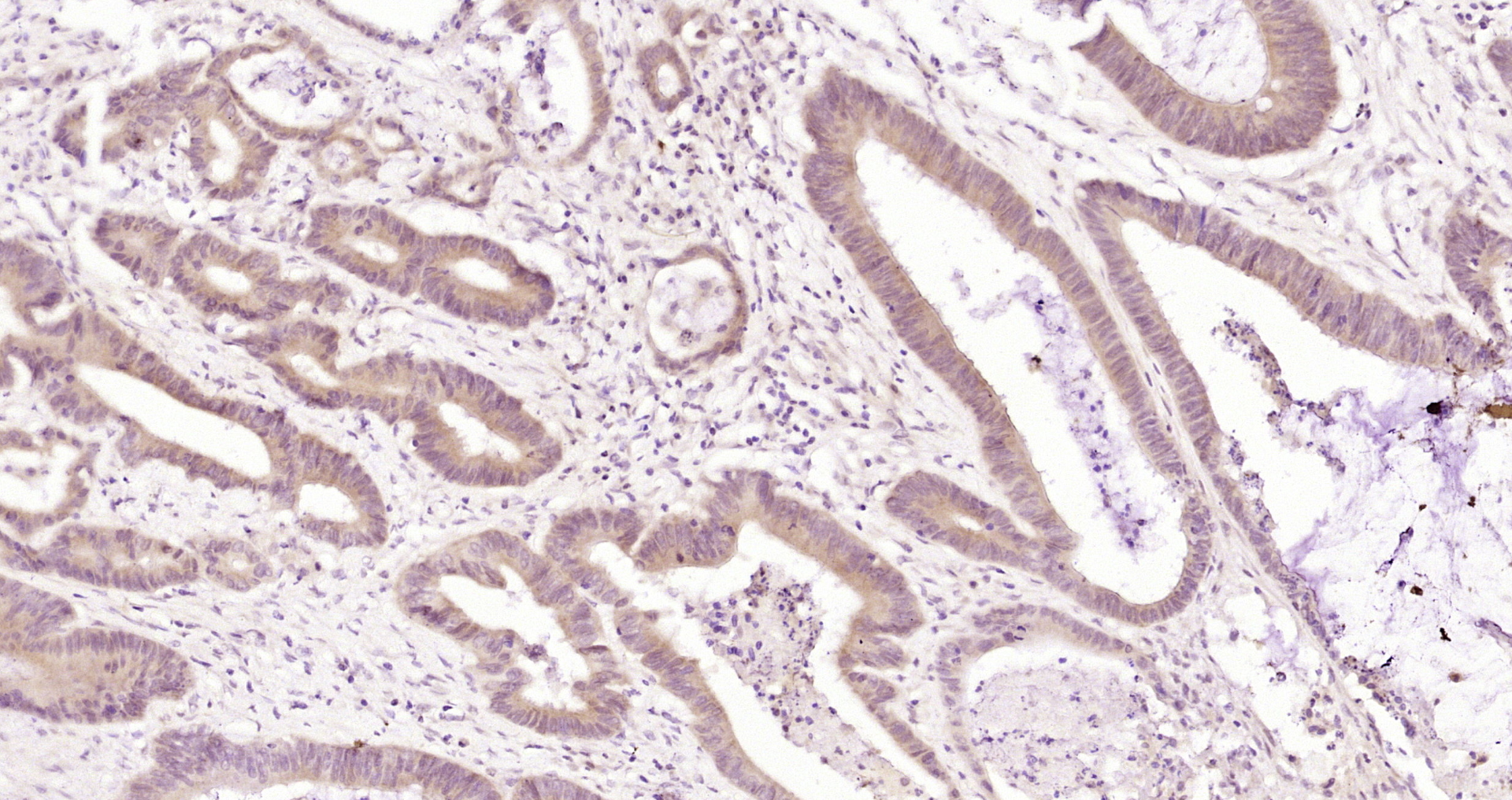 Paraformaldehyde-fixed, paraffin embedded Human colon cancer; Antigen retrieval by boiling in sodium citrate buffer (pH6.0) for 15min; Block endogenous peroxidase by 3% hydrogen peroxide for 20 minutes; Blocking buffer (normal goat serum) at 37°C for 30min; Antibody incubation with Gemin 4 Polyclonal Antibody, Unconjugated (bs-13328R) at 1:200 overnight at 4°C, DAB staining.