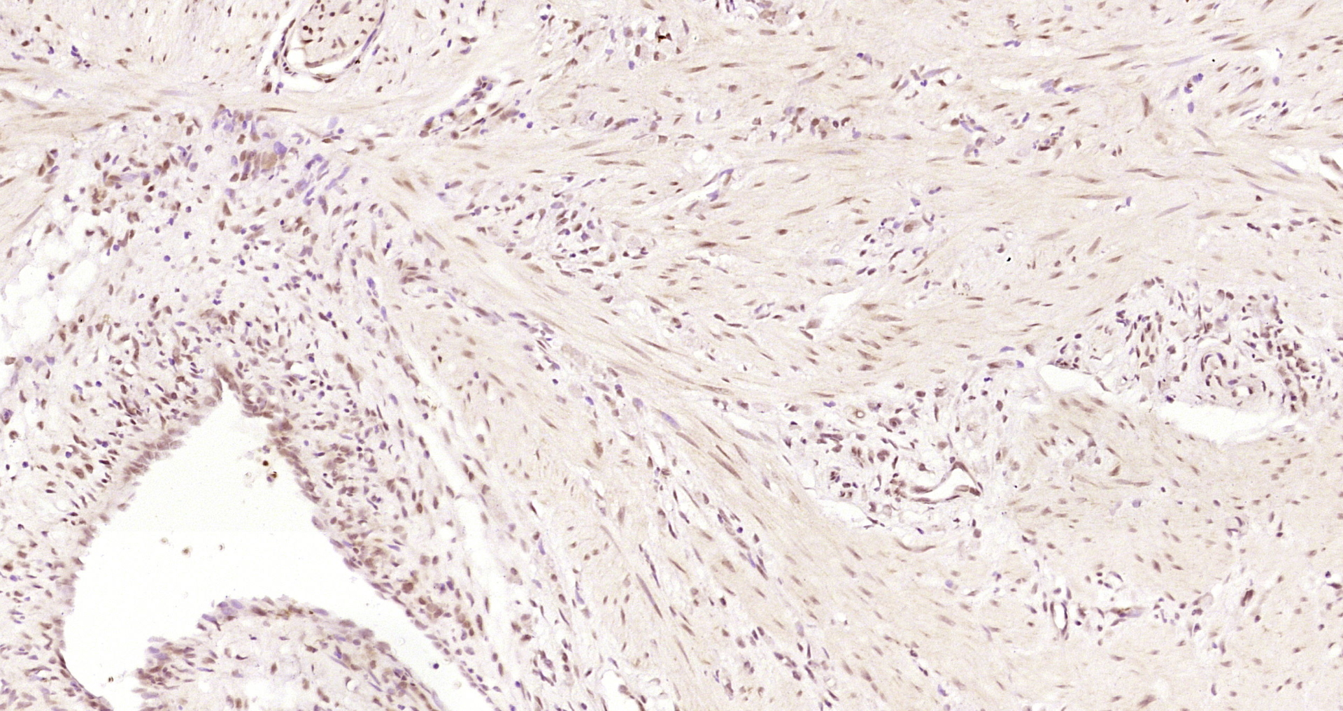 Paraformaldehyde-fixed, paraffin embedded Human stomach cancer; Antigen retrieval by boiling in sodium citrate buffer (pH6.0) for 15min; Block endogenous peroxidase by 3% hydrogen peroxide for 20 minutes; Blocking buffer (normal goat serum) at 37°C for 30min; Antibody incubation with GEM Polyclonal Antibody, Unconjugated (bs-13331R) at 1:200 overnight at 4°C, DAB staining.