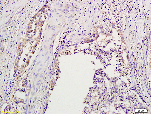 Formalin-fixed and paraffin embedded human ovary labeled with Anti-Aurora B/STK-1 Polyclonal Antibody, Unconjugated (bs-2445R) at 1:200 followed by conjugation to the secondary antibody