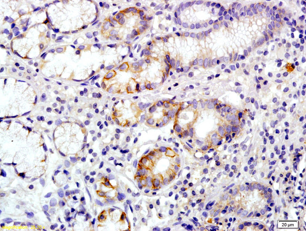 Formalin-fixed and paraffin embedded human colon carcinoma labeled with Rabbit Anti Annexin A13 Polyclonal Antibody, Unconjugated (bs-12478R) at 1:200 followed by conjugation to the secondary antibody and DAB staining