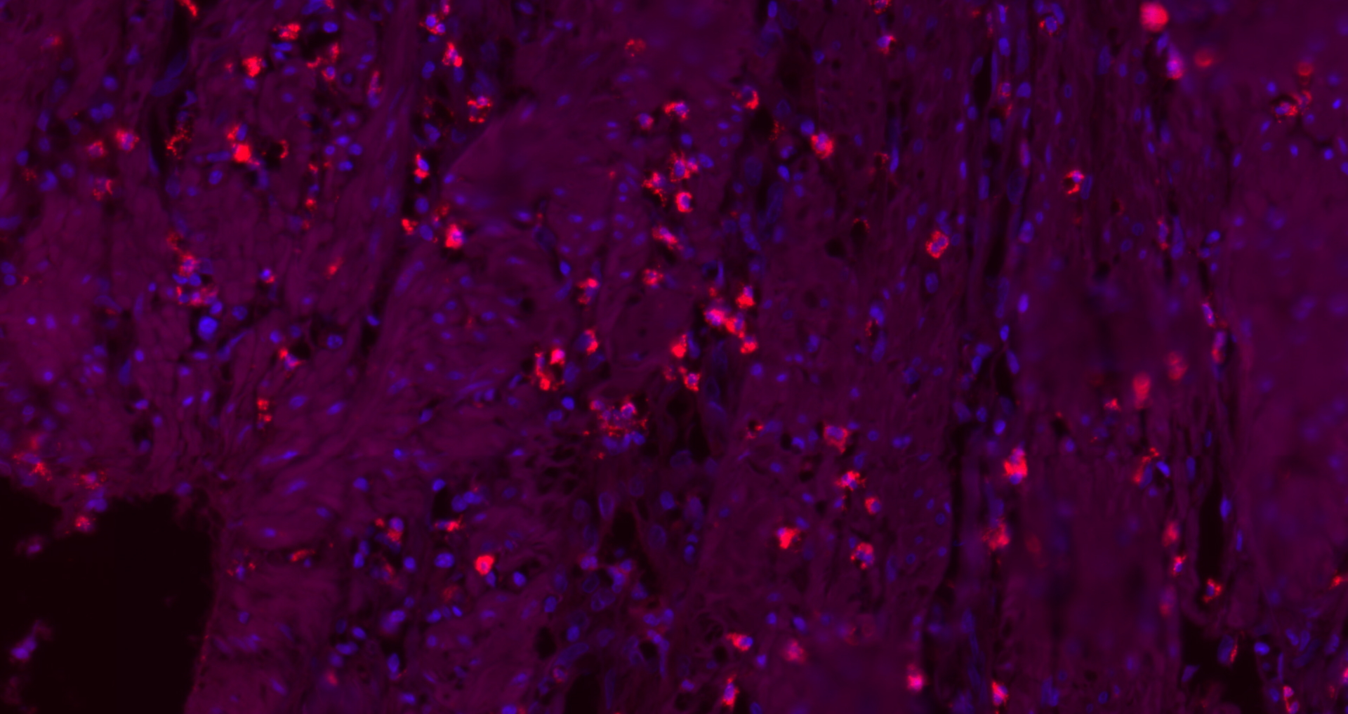 Paraformaldehyde-fixed, paraffin embedded Human colon cancer; Antigen retrieval by boiling in sodium citrate buffer (pH6.0) for 15min; Block endogenous peroxidase by 3% hydrogen peroxide for 20 minutes; Blocking buffer (normal goat serum) at 37°C for 30min; Antibody incubation with CK16 Monoclonal Antibody, Unconjugated (bsm-33062M) at 1:200 overnight at 4°C, followed by a conjugated Goat Anti-Mouse IgG antibody (bs-0296G-cy3) for 90 minutes, and DAPI for nuclei staining.