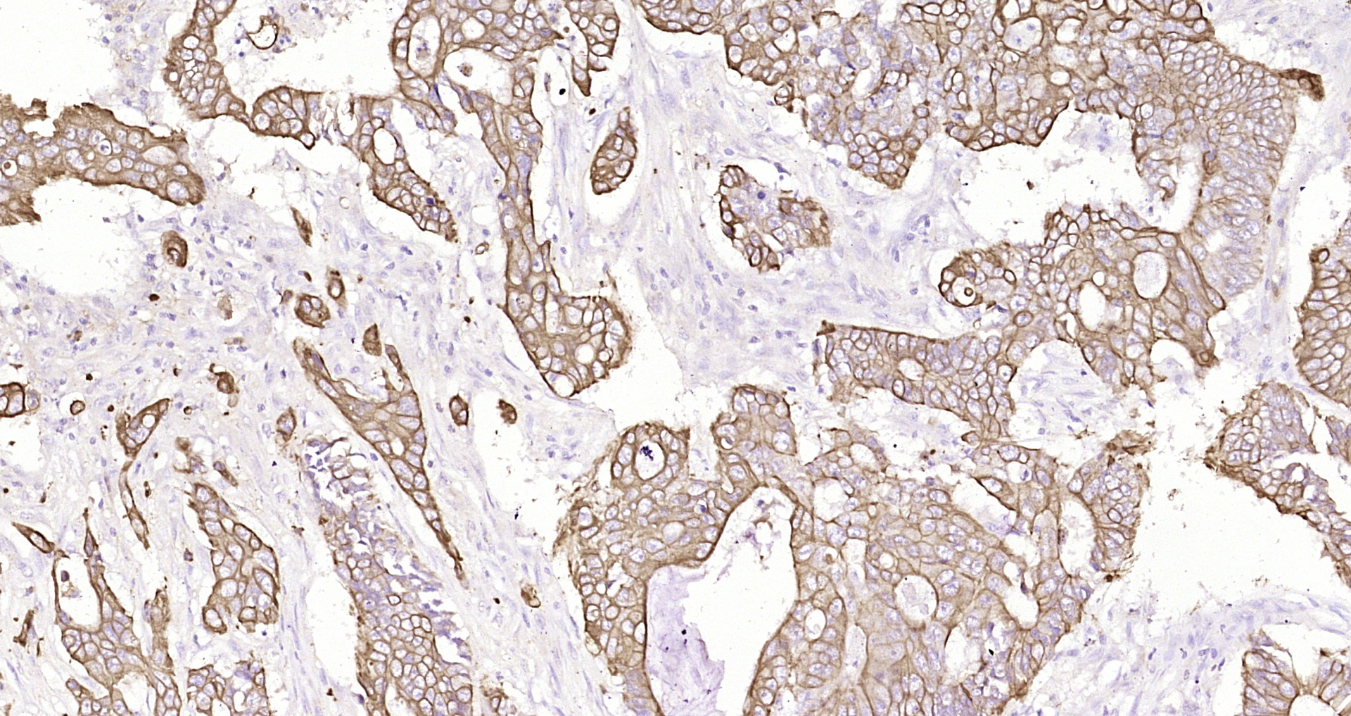 Paraformaldehyde-fixed, paraffin embedded Human colon cancer; Antigen retrieval by boiling in sodium citrate buffer (pH6.0) for 15min; Block endogenous peroxidase by 3% hydrogen peroxide for 20 minutes; Blocking buffer (normal goat serum) at 37°C for 30min; Antibody incubation with CK16 Monoclonal Antibody, Unconjugated (bsm-33062M) at 1:400 overnight at 4°C, DAB staining.