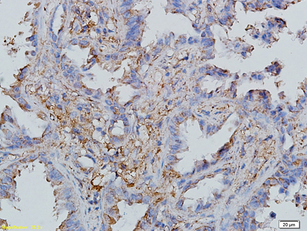 Formalin-fixed and paraffin embedded human endometrial cancer labeled with Anti-CCL19/MIP-3 beta Polyclonal Antibody, Unconjugated (bs-2454R) followed by conjugation to the secondary antibody