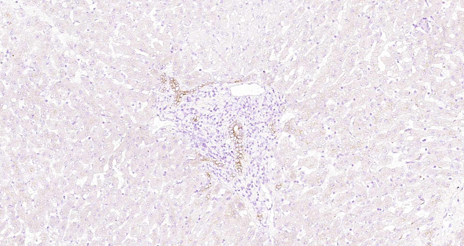 Paraformaldehyde-fixed, paraffin embedded Human liver cancer; Antigen retrieval by boiling in sodium citrate buffer (pH6.0) for 15min; Block endogenous peroxidase by 3% hydrogen peroxide for 20 minutes; Blocking buffer (normal goat serum) at 37°C for 30min; Antibody incubation with _x000D_ CK18 Monoclonal Antibody, Unconjugated (bsm-33103M) at 1:800 overnight at 4°C, DAB staining.
