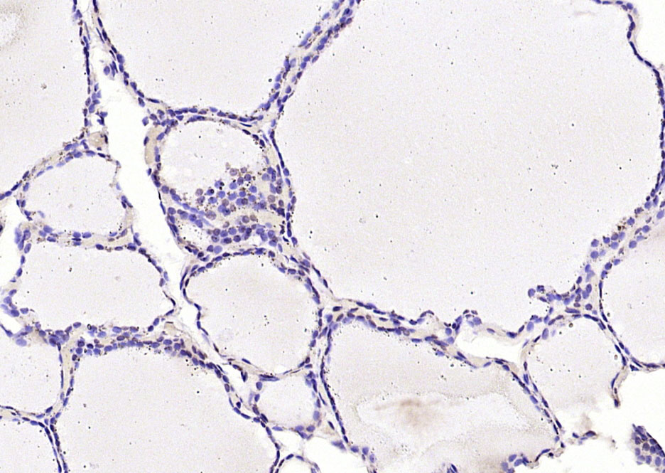 Paraformaldehyde-fixed, paraffin embedded Human thyroid; Antigen retrieval by boiling in sodium citrate buffer (pH6.0) for 15min; Block endogenous peroxidase by 3% hydrogen peroxide for 20 minutes; Blocking buffer (normal goat serum) at 37°C for 30min; Antibody incubation with UBE2V1 Polyclonal Antibody, Unconjugated (bs-7882R) at 1:200 overnight at 4°C, DAB staining.