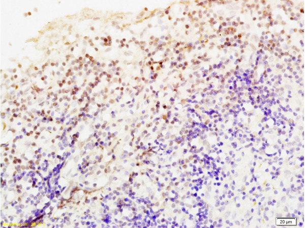 Formalin-fixed and paraffin embedded Human endometrium carcinoma labeled Anti-Livin Polyclonal Antibody, Unconjugated (bs-0738R) at 1:200, followed by conjugation to the secondary antibody and DAB staining