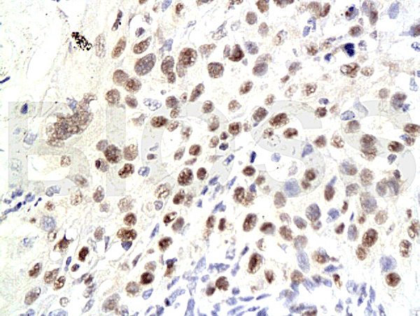 Formalin-fixed and paraffin embedded human laryngeal squamous cell carcinoma labeled Anti-P21\/CDKN1A Polyclonal Antibody, Unconjugated (bs-0741R) at 1:200, followed by conjugation to the secondary antibody and DAB staining