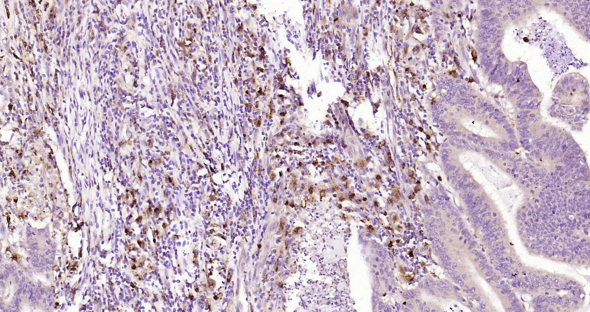 Paraformaldehyde-fixed, paraffin embedded Human colon cancer; Antigen retrieval by boiling in sodium citrate buffer (pH6.0) for 15min; Block endogenous peroxidase by 3% hydrogen peroxide for 20 minutes; Blocking buffer (normal goat serum) at 37°C for 30min; Antibody incubation with SPR/Sepiapterin reductase Polyclonal Antibody, Unconjugated (bs-11784R) at 1:200 overnight at 4°C, DAB staining.