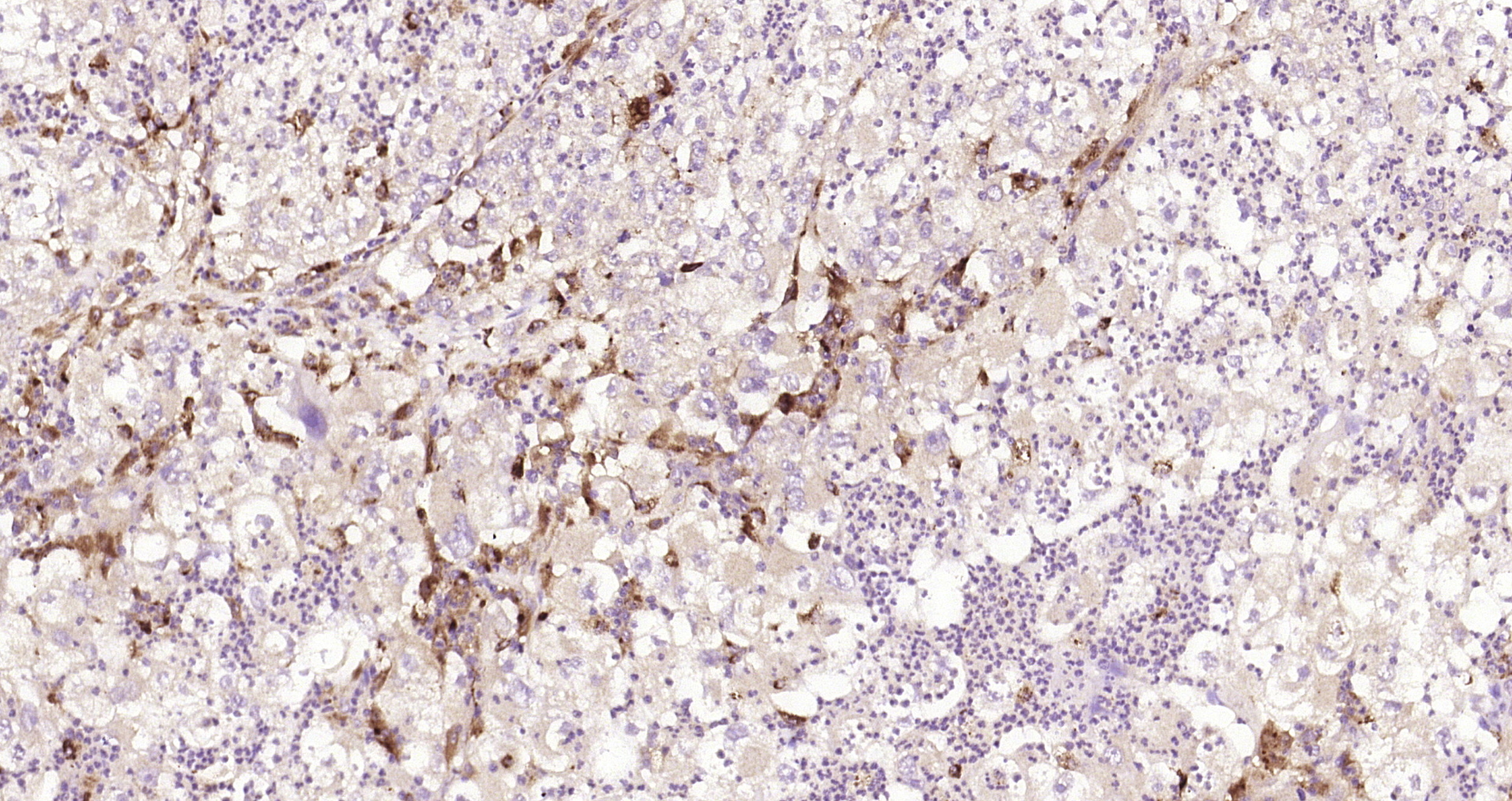 Paraformaldehyde-fixed, paraffin embedded Human endometrial carcinoma; Antigen retrieval by boiling in sodium citrate buffer (pH6.0) for 15min; Block endogenous peroxidase by 3% hydrogen peroxide for 20 minutes; Blocking buffer (normal goat serum) at 37°C for 30min; Antibody incubation with SPR/Sepiapterin reductase Polyclonal Antibody, Unconjugated (bs-11784R) at 1:200 overnight at 4°C, DAB staining.