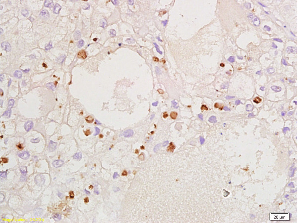 Formalin-fixed and paraffin embedded human ovary carcinoma labeled Anti-CDKN1B/P27kip1 Polyclonal Antibody, Unconjugated (bs-0742R) at 1:200, followed by conjugation to the secondary antibody and DAB staining