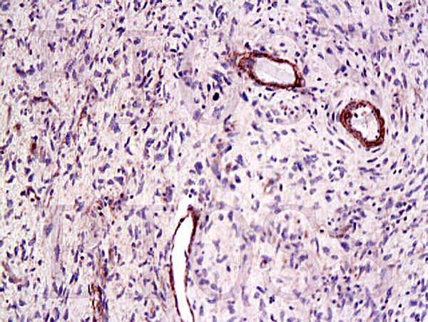 Formalin-fixed and paraffin embedded human laryngeal cancer labeled Anti-CTGF Polyclonal Antibody, Unconjugated (bs-0743R) at 1:200, followed by conjugation to the secondary antibody and DAB staining
