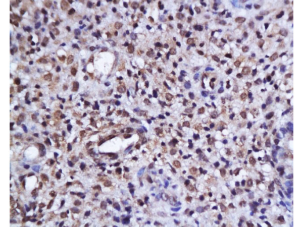Formalin-fixed and paraffin embedded human endometrium tissue labeled with Anti-phospho-AKT\/PKB(Ser473) Polyclonal Antibody, Unconjugated (bs-0876R) at 1:200, followed by conjugation to the secondary antibody and DAB staining