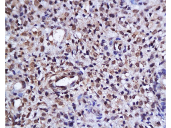 Formalin-fixed and paraffin embedded human endometrium tissue labeled with Anti-phospho-AKT/PKB(Ser473) Polyclonal Antibody, Unconjugated (bs-0876R) at 1:200, followed by conjugation to the secondary antibody and DAB staining