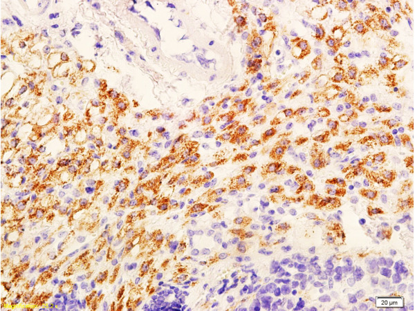Formalin-fixed and paraffin embedded mouse tumor with labeled Anti-phospho-AKT\/PKB(Ser473) Polyclonal Antibody, Unconjugated (bs-0876R) at 1:600, followed by conjugation to the secondary antibody and DAB staining