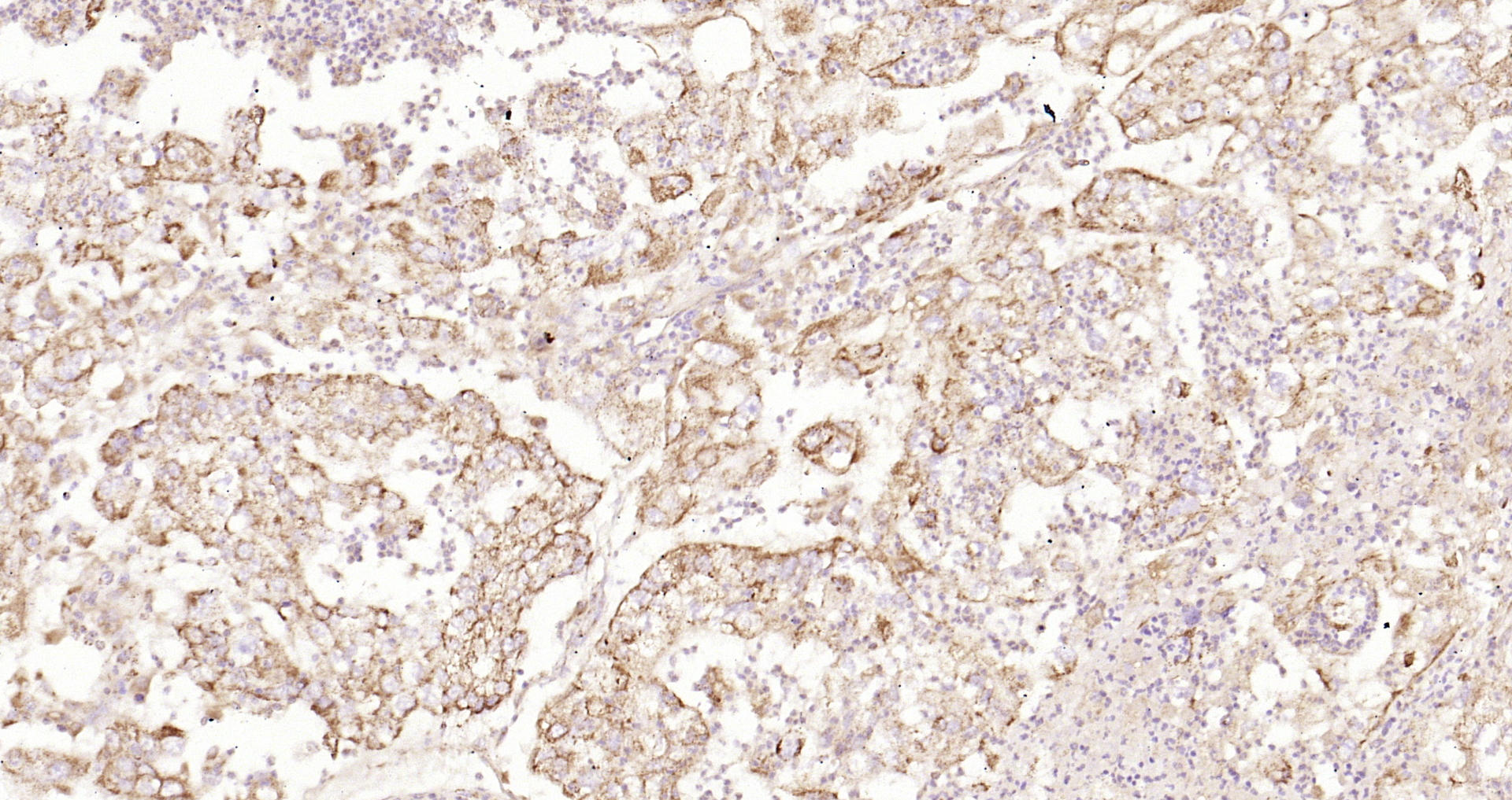 Paraformaldehyde-fixed, paraffin embedded Human endometrial carcinoma; Antigen retrieval by boiling in sodium citrate buffer (pH6.0) for 15min; Block endogenous peroxidase by 3% hydrogen peroxide for 20 minutes; Blocking buffer (normal goat serum) at 37°C for 30min; Antibody incubation with Ecat1 Polyclonal Antibody, Unconjugated (bs-13596R) at 1:200 overnight at 4°C, DAB staining.