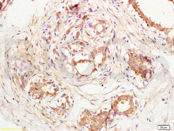 Formalin-fixed and paraffin embedded human breast carcinoma labeled with Anti-CD144\/VECD\/VE Cadherin Polyclonal Antibody, Unconjugated (bs-0878R)  at 1:200, followed by conjugation to the secondary antibody and DAB staining