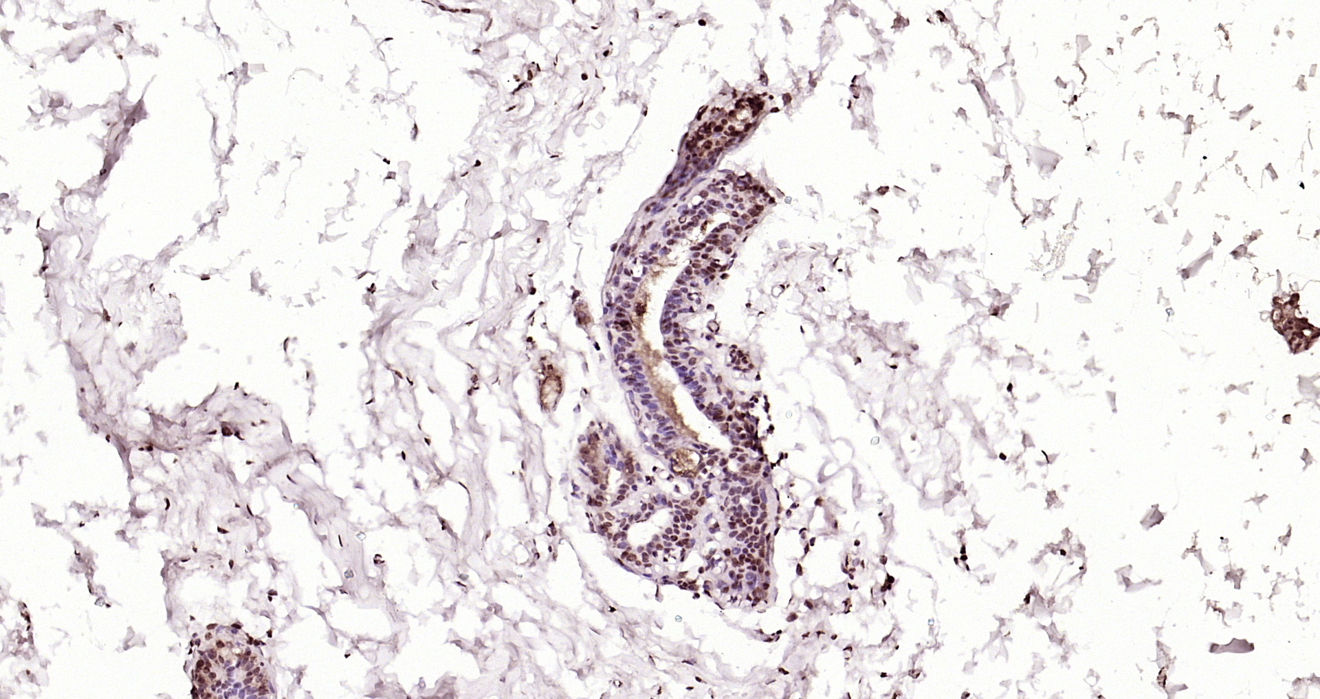 Paraformaldehyde-fixed, paraffin embedded Human breast cancer; Antigen retrieval by boiling in sodium citrate buffer (pH6.0) for 15min; Block endogenous peroxidase by 3% hydrogen peroxide for 20 minutes; Blocking buffer (normal goat serum) at 37°C for 30min; Antibody incubation with MAS1L Polyclonal Antibody, Unconjugated (bs-5926R) at 1:200 overnight at 4°C, DAB staining.