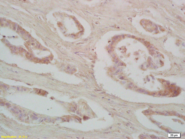 Formalin-fixed and paraffin embedded human colon carcinoma labeled with Rabbit Anti IRS-2 Polyclonal Antibody, Unconjugated (bs-0173R) at 1:200 followed by conjugation to the secondary antibody and DAB staining