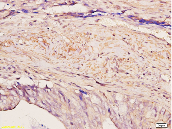 Formalin-fixed and paraffin embedded human colon carcinoma with Anti-Pokemon Polyclonal Antibody, Unconjugated (bs-0891R) at 1:200, followed by conjugation to the secondary antibody and DAB staining