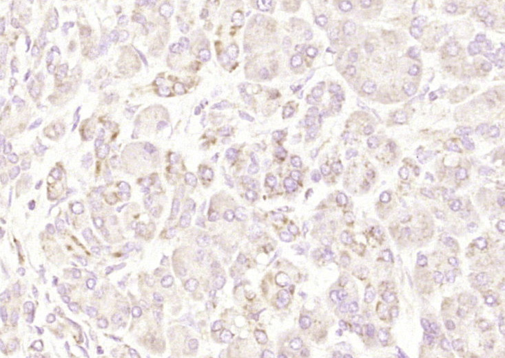 Paraformaldehyde-fixed, paraffin embedded Human pancreatic cancer; Antigen retrieval by boiling in sodium citrate buffer (pH6.0) for 15min; Block endogenous peroxidase by 3% hydrogen peroxide for 20 minutes; Blocking buffer (normal goat serum) at 37°C for 30min; Antibody incubation with IFN-beta Polyclonal Antibody, Unconjugated (bs-0787R) at 1:200 overnight at 4°C, DAB staining.