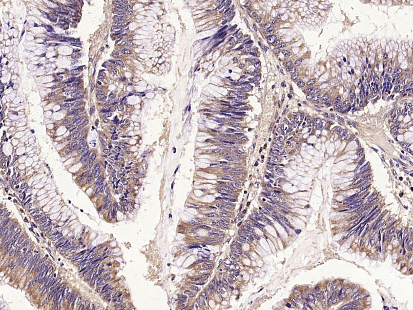 Paraformaldehyde-fixed, paraffin embedded Human colon cancer; Antigen retrieval by boiling in sodium citrate buffer (pH6.0) for 15min; Block endogenous peroxidase by 3% hydrogen peroxide for 20 minutes; Blocking buffer (normal goat serum) at 37°C for 30min; Antibody incubation with E cadherin Polyclonal Antibody, Unconjugated (bs-10009R) at 1:400 overnight at 4°C, DAB staining.