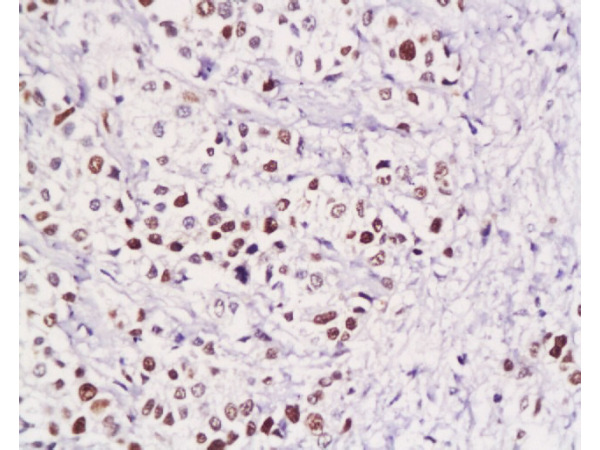 Formalin-fixed and paraffin embedded human gastric carcinoma with Anti-Pokemon Polyclonal Antibody, Unconjugated (bs-0891R) at 1:200, followed by conjugation to the secondary antibody and DAB staining