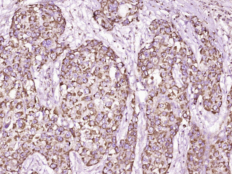 Paraformaldehyde-fixed, paraffin embedded Human liver cancer; Antigen retrieval by boiling in sodium citrate buffer (pH6.0) for 15min; Block endogenous peroxidase by 3% hydrogen peroxide for 20 minutes; Blocking buffer (normal goat serum) at 37°C for 30min; Antibody incubation with SOD1 Polyclonal Antibody, Unconjugated (bs-10216R) at 1:200 overnight at 4°C, DAB staining.