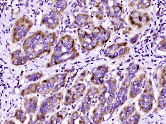 Paraformaldehyde-fixed, paraffin embedded Human liver cancer; Antigen retrieval by boiling in sodium citrate buffer (pH6.0) for 15min; Block endogenous peroxidase by 3% hydrogen peroxide for 20 minutes; Blocking buffer (normal goat serum) at 37°C for 30min; Antibody incubation with DCP Polyclonal Antibody, Unconjugated (bs-1037R) at 1:400 overnight at 4°C, DAB staining.