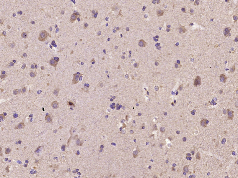 Paraformaldehyde-fixed, paraffin embedded Human brain glioma; Antigen retrieval by boiling in sodium citrate buffer (pH6.0) for 15min; Block endogenous peroxidase by 3% hydrogen peroxide for 20 minutes; Blocking buffer (normal goat serum) at 37°C for 30min; Antibody incubation with STAT6 Polyclonal Antibody, Unconjugated (bs-1143R) at 1:400 overnight at 4°C, DAB staining. Paraformaldehyde-fixed, paraffin embedded Human brain glioma; Antigen retrieval by boiling in sodium citrate buffer (pH6.0) for 15min; Block endogenous peroxidase by 3% hydrogen peroxide for 20 minutes; Blocking buffer (normal goat serum) at 37°C for 30min; Antibody incubation with STAT6 Polyclonal Antibody, Unconjugated (bs-1143R) at 1:400 overnight at 4°C, DAB staining.