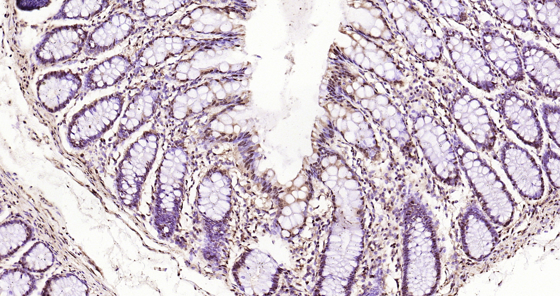 Paraformaldehyde-fixed, paraffin embedded Human colon; Antigen retrieval by boiling in sodium citrate buffer (pH6.0) for 15min; Block endogenous peroxidase by 3% hydrogen peroxide for 20 minutes; Blocking buffer (normal goat serum) at 37°C for 30min; Antibody incubation with GAPDH Polyclonal Antibody, Unconjugated (bs-10900R) at 1:200 overnight at 4°C, DAB staining.