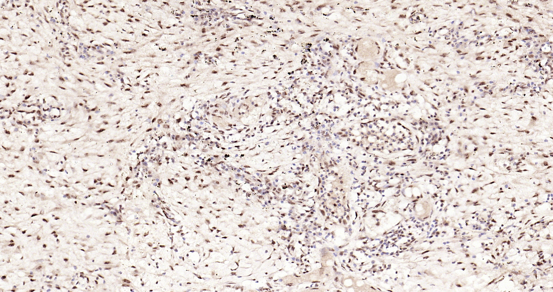 Paraformaldehyde-fixed, paraffin embedded Human colon cancer; Antigen retrieval by boiling in sodium citrate buffer (pH6.0) for 15min; Block endogenous peroxidase by 3% hydrogen peroxide for 20 minutes; Blocking buffer (normal goat serum) at 37°C for 30min; Antibody incubation with STAT3 (Tyr705) Monoclonal Antibody, Unconjugated (bsm-33301M) at 1:200 overnight at 4°C, DAB staining.