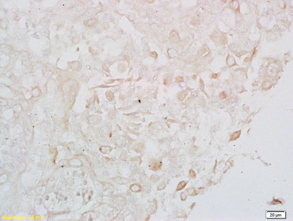 Formalin-fixed and paraffin embedded human cervical carcinoma labeled with Anti- LONP1 Polyclonal Antibody, Unconjugated (bs-4245R) at 1:200 followed by conjugation to the secondary antibody