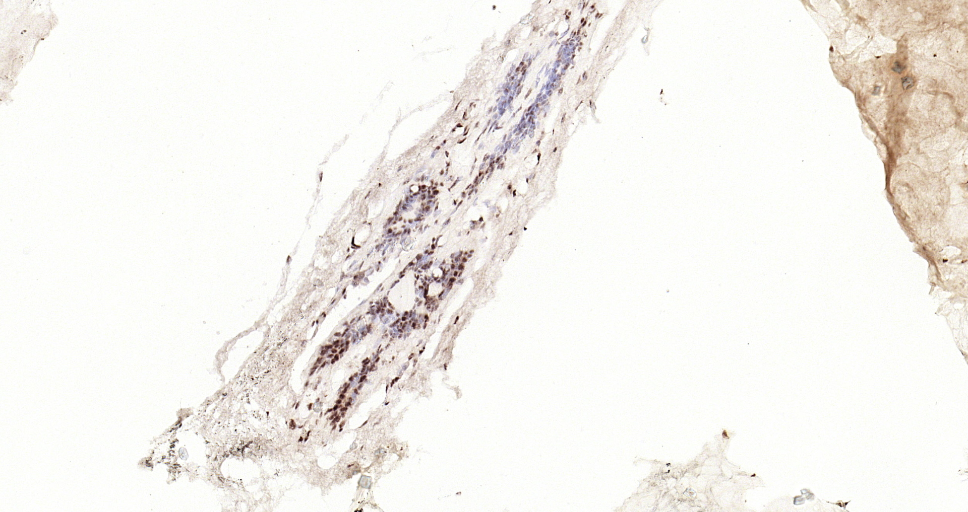 Paraformaldehyde-fixed, paraffin embedded Human breast cancer; Antigen retrieval by boiling in sodium citrate buffer (pH6.0) for 15min; Block endogenous peroxidase by 3% hydrogen peroxide for 20 minutes; Blocking buffer (normal goat serum) at 37°C for 30min; Antibody incubation with STAT3 (Tyr705) Monoclonal Antibody, Unconjugated (bsm-33301M) at 1:200 overnight at 4°C, DAB staining.