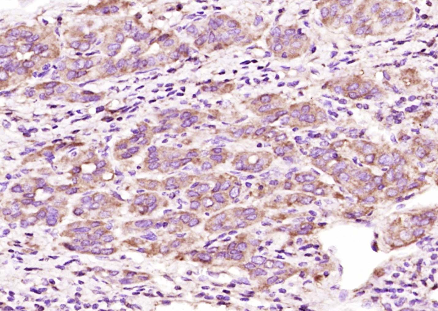 Paraformaldehyde-fixed, paraffin embedded Human liver cancer; Antigen retrieval by boiling in sodium citrate buffer (pH6.0) for 15min; Block endogenous peroxidase by 3% hydrogen peroxide for 20 minutes; Blocking buffer (normal goat serum) at 37°C for 30min; Antibody incubation with GIPC1 Polyclonal Antibody, Unconjugated (bs-12304R) at 1:400 overnight at 4°C, DAB staining.