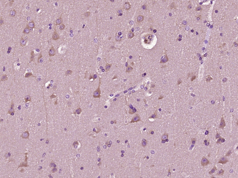 Paraformaldehyde-fixed, paraffin embedded Human brain glioma; Antigen retrieval by boiling in sodium citrate buffer (pH6.0) for 15min; Block endogenous peroxidase by 3% hydrogen peroxide for 20 minutes; Blocking buffer (normal goat serum) at 37\u00b0C for 30min; Antibody incubation with MAP2\/MAP-2a.b.c Polyclonal Antibody, Unconjugated (bs-1369R) at 1:400 overnight at 4\u00b0C, DAB staining.