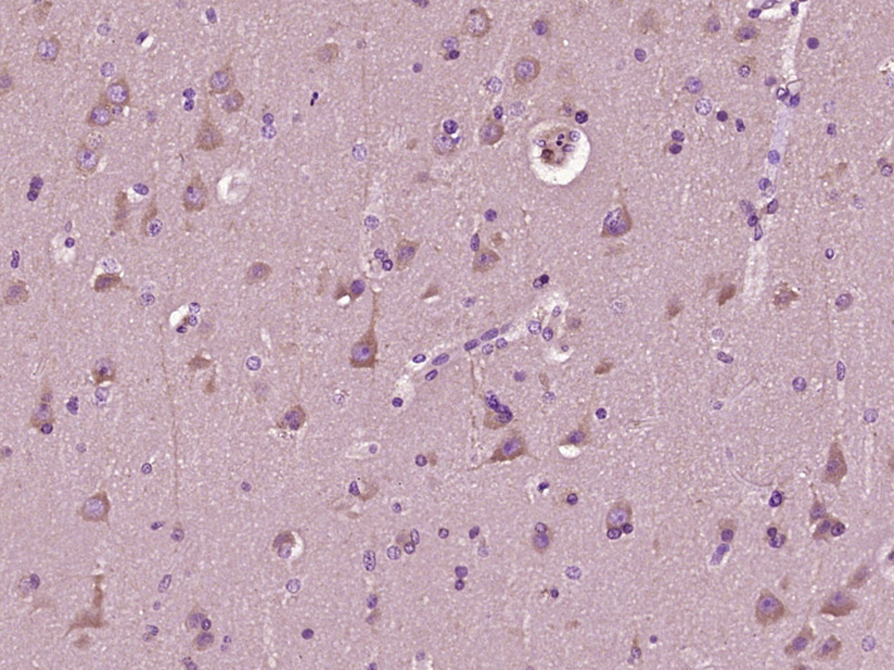 Paraformaldehyde-fixed, paraffin embedded Human brain glioma; Antigen retrieval by boiling in sodium citrate buffer (pH6.0) for 15min; Block endogenous peroxidase by 3% hydrogen peroxide for 20 minutes; Blocking buffer (normal goat serum) at 37°C for 30min; Antibody incubation with MAP2/MAP-2a.b.c Polyclonal Antibody, Unconjugated (bs-1369R) at 1:400 overnight at 4°C, DAB staining.
