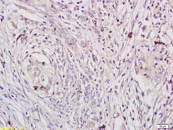 Formalin-fixed and paraffin embedded human gastric cancer labeled with Anti-phospho-DAXX (Ser495) Polyclonal Antibody, Unconjugated (bs-5291R) at 1:200 followed by conjugation to the secondary antibody