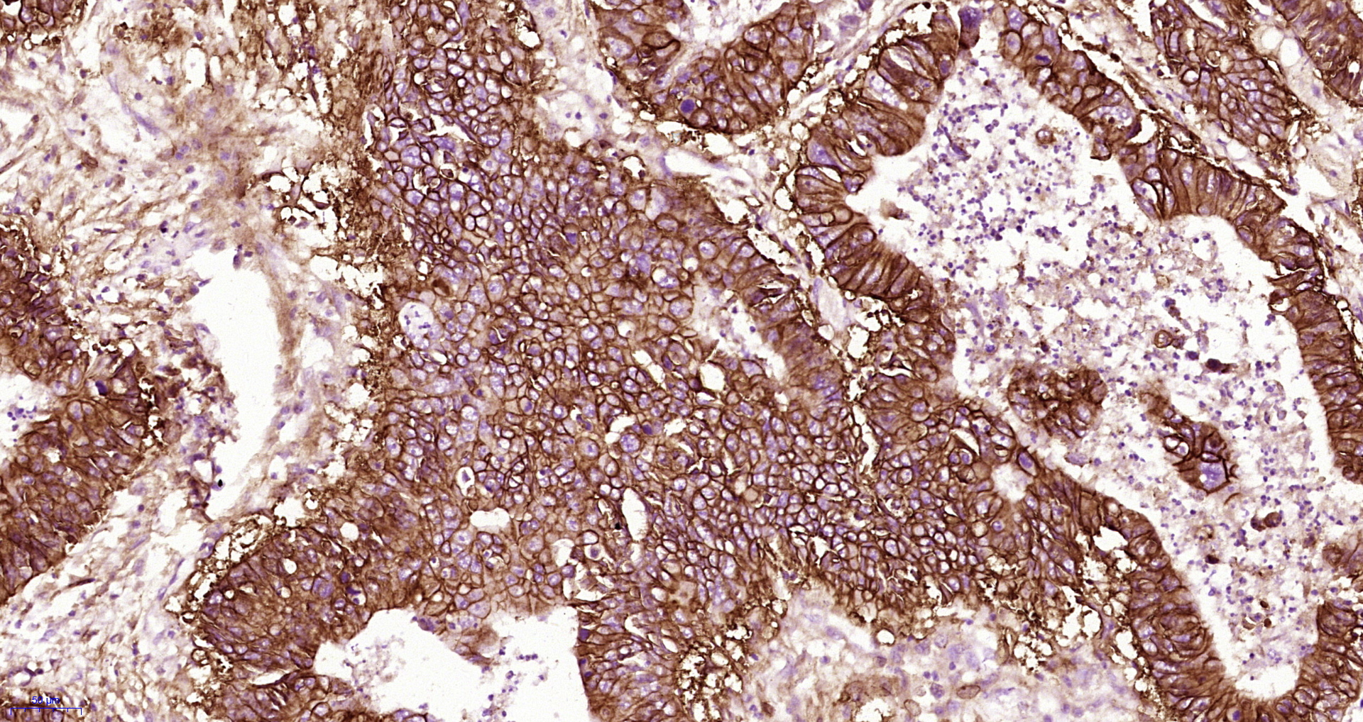 Paraformaldehyde-fixed, paraffin embedded Human gastric carcinoma; Antigen retrieval by boiling in sodium citrate buffer (pH6.0) for 15min; Block endogenous peroxidase by 3% hydrogen peroxide for 20 minutes; Blocking buffer (normal goat serum) at 37°C for 30min; Antibody incubation with EpCAM/CD326 Polyclonal Antibody, Unconjugated (bs-1513R) at 1:400 overnight at 4°C, DAB staining.
