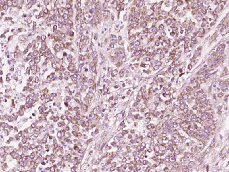 Paraformaldehyde-fixed, paraffin embedded Human colon cancer; Antigen retrieval by boiling in sodium citrate buffer (pH6.0) for 15min; Block endogenous peroxidase by 3% hydrogen peroxide for 20 minutes; Blocking buffer (normal goat serum) at 37°C for 30min; Antibody incubation with CD46/MCP Polyclonal Antibody, Unconjugated (bs-1529R) at 1:400 overnight at 4°C, DAB staining.