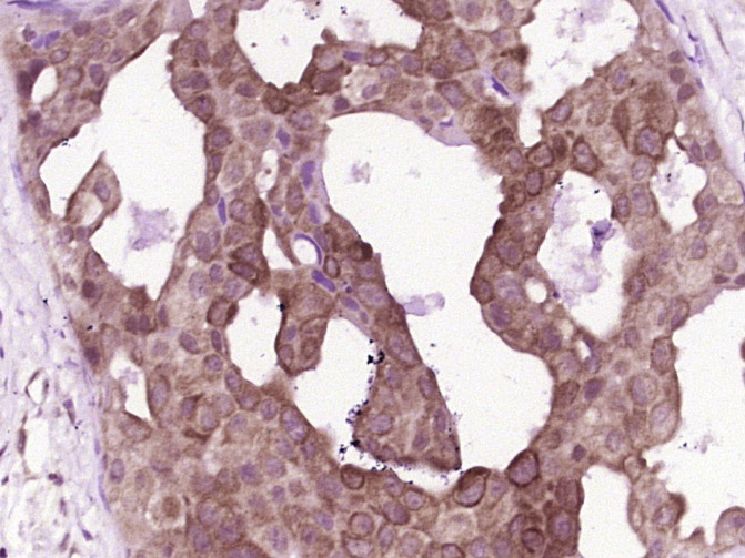 Paraformaldehyde-fixed, paraffin embedded Human breast cancer; Antigen retrieval by boiling in sodium citrate buffer (pH6.0) for 15min; Block endogenous peroxidase by 3% hydrogen peroxide for 20 minutes; Blocking buffer (normal goat serum) at 37°C for 30min; Antibody incubation with Calpain 2 Polyclonal Antibody, Unconjugated (bs-1599R) at 1:400 overnight at 4°C, DAB staining.