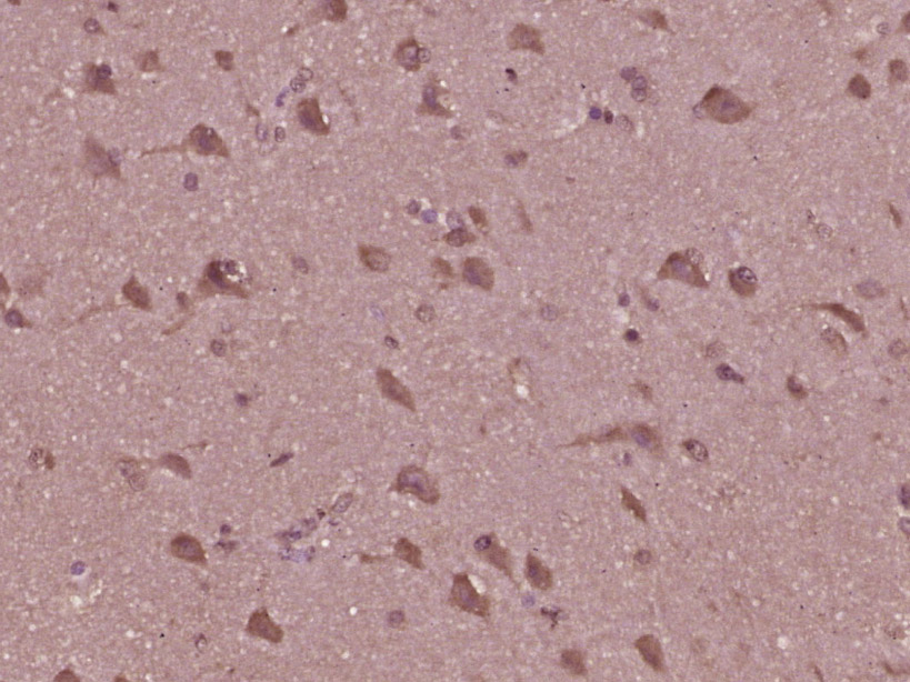 Paraformaldehyde-fixed, paraffin embedded Human brain glioma; Antigen retrieval by boiling in sodium citrate buffer (pH6.0) for 15min; Block endogenous peroxidase by 3% hydrogen peroxide for 20 minutes; Blocking buffer (normal goat serum) at 37°C for 30min; Antibody incubation with JNK1+2+3 (T183+Y185) Polyclonal Antibody, Unconjugated (bs-1640R) at 1:400 overnight at 4°C, DAB staining.