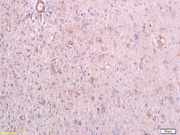 Formalin-fixed and paraffin embedded human endometrial carcinoma labeled with Anti-phospho-PRKCQ(Thr538) Polyclonal Antibody, Unconjugated (bs-5585R) at 1:200 followed by conjugation to the secondary antibody