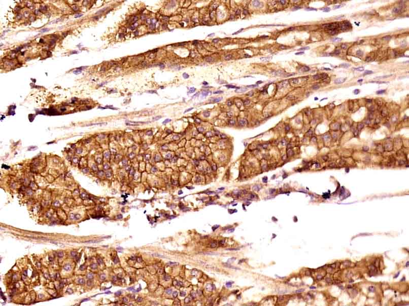 Paraformaldehyde-fixed, paraffin embedded Human gastric carcinoma; Antigen retrieval by boiling in sodium citrate buffer (pH6.0) for 15min; Block endogenous peroxidase by 3% hydrogen peroxide for 20 minutes; Blocking buffer (normal goat serum) at 37°C for 30min; Antibody incubation with _x000D_ TEM1/CD248 Polyclonal Antibody, Unconjugated (bs-2101R) at 1:400 overnight at 4°C, DAB staining.