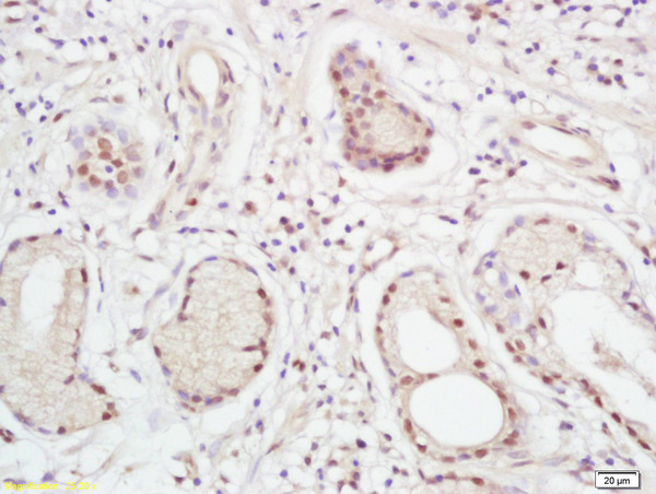 Formalin-fixed and paraffin embedded human gastric cancer labeled with Anti-XPC Polyclonal Antibody, Unconjugated (bs-6468R) at 1:200 followed by conjugation to the secondary antibody