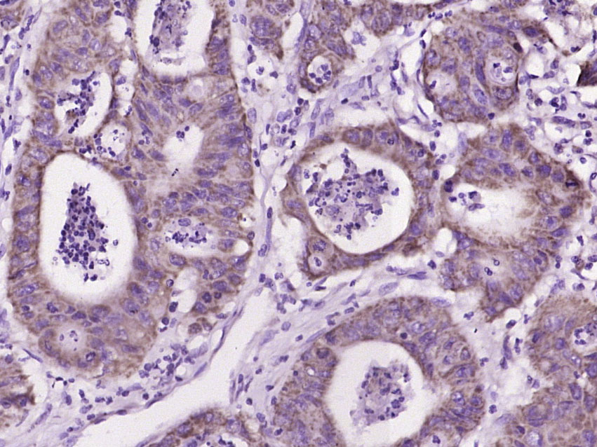 Paraformaldehyde-fixed, paraffin embedded Human colon cancer; Antigen retrieval by boiling in sodium citrate buffer (pH6.0) for 15min; Block endogenous peroxidase by 3% hydrogen peroxide for 20 minutes; Blocking buffer (normal goat serum) at 37°C for 30min; Antibody incubation with _x000D_ IL-17C Polyclonal Antibody, Unconjugated (bs-2611R) at 1:400 overnight at 4°C, DAB staining.