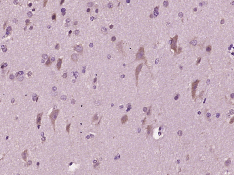 Paraformaldehyde-fixed, paraffin embedded Human brain glioma; Antigen retrieval by boiling in sodium citrate buffer (pH6.0) for 15min; Block endogenous peroxidase by 3% hydrogen peroxide for 20 minutes; Blocking buffer (normal goat serum) at 37°C for 30min; Antibody incubation with MCT4 Polyclonal Antibody, Unconjugated (bs-2698R) at 1:400 overnight at 4°C, DAB staining.