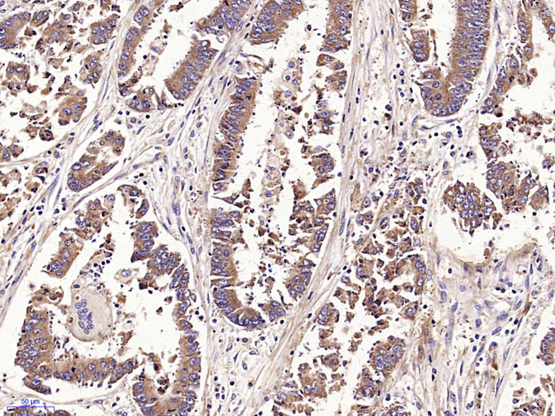 Paraformaldehyde-fixed, paraffin embedded Human gastric carcinoma; Antigen retrieval by boiling in sodium citrate buffer (pH6.0) for 15min; Block endogenous peroxidase by 3% hydrogen peroxide for 20 minutes; Blocking buffer (normal goat serum) at 37°C for 30min; Antibody incubation with ADM2 Polyclonal Antibody, Unconjugated (bs-2985R) at 1:400 overnight at 4°C, DAB staining.