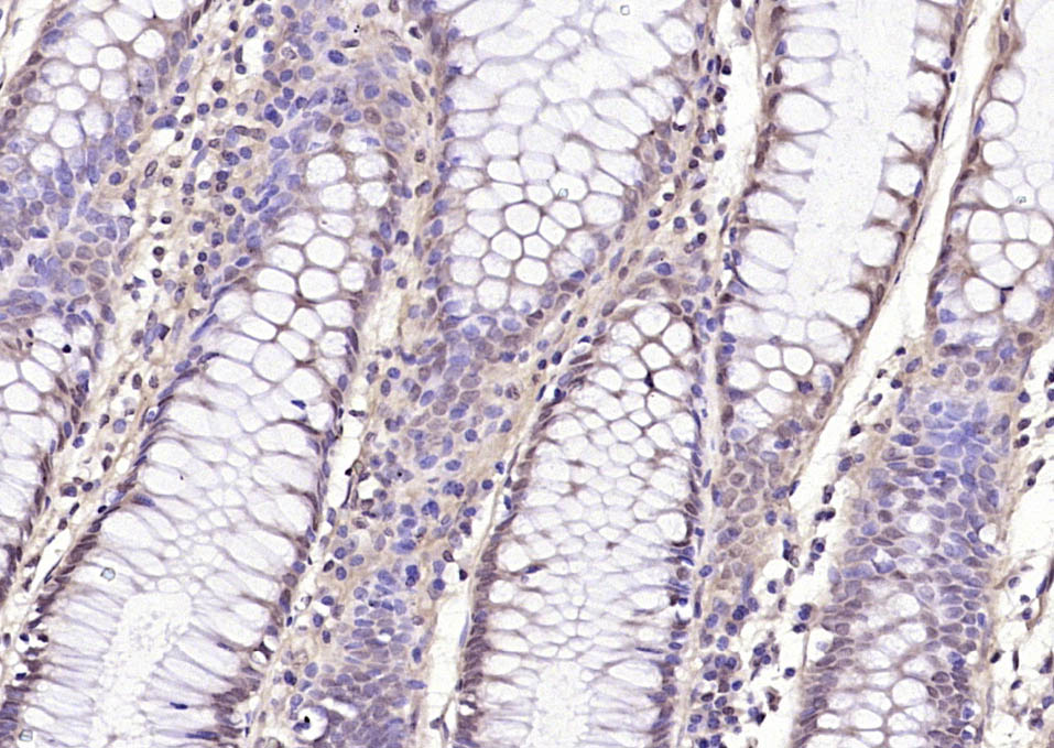 Paraformaldehyde-fixed, paraffin embedded Human colon cancer; Antigen retrieval by boiling in sodium citrate buffer (pH6.0) for 15min; Block endogenous peroxidase by 3% hydrogen peroxide for 20 minutes; Blocking buffer (normal goat serum) at 37°C for 30min; Antibody incubation with HDAC4(Ser246)/HDAC5(Ser259)/HDAC7(Ser155) Polyclonal Antibody, Unconjugated (bs-3073R) at 1:200 overnight at 4°C, DAB staining.