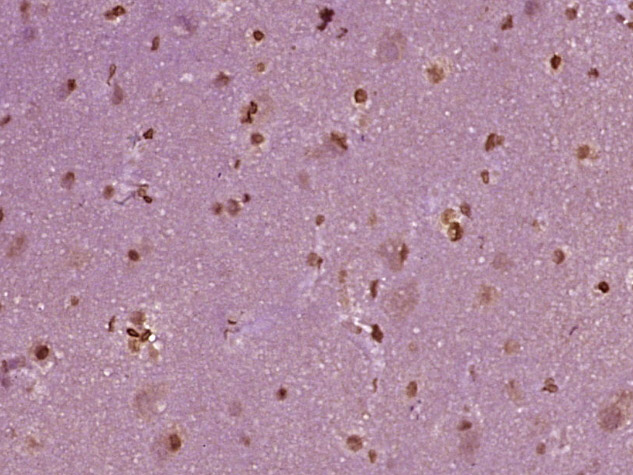 Paraformaldehyde-fixed, paraffin embedded Human brain glioma; Antigen retrieval by boiling in sodium citrate buffer (pH6.0) for 15min; Block endogenous peroxidase by 3% hydrogen peroxide for 20 minutes; Blocking buffer (normal goat serum) at 37°C for 30min; Antibody incubation with KEAP1 Polyclonal Antibody, Unconjugated (bs-3648R) at 1:400 overnight at 4°C, DAB staining.